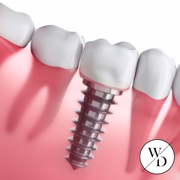 Dental Implants Sutton Coldfield